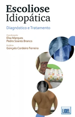 Escoliose Idiopática - Diagnóstico e Tratamento-Diagnóstico e Tratamento